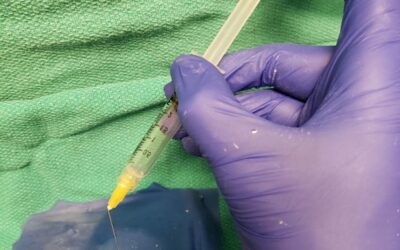 UNMC dentist identifies new uses for Precision Syringe